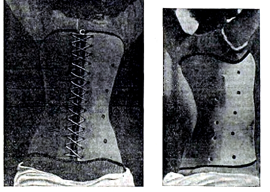Рис. 2. Целлулоидный корсет. Вид спереди. Вид сзади.